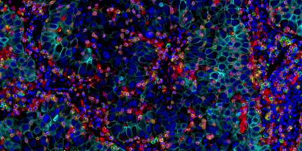 23-CAN-85660_IHC lung